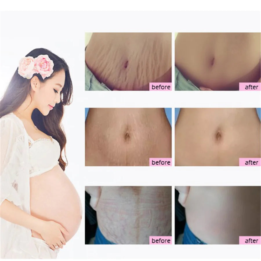 Mango Antenatal Cream - RtopR Body Cream RtopR