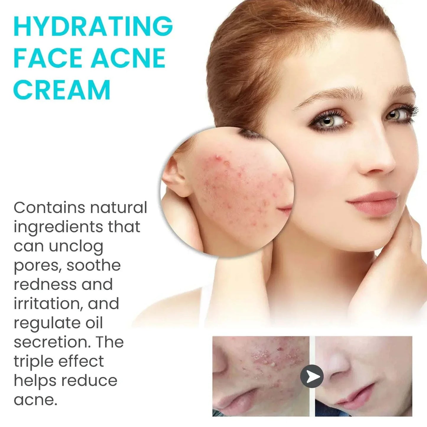 Jaysuing Whitening Anti-Acne Cream brightening and acne care benefits