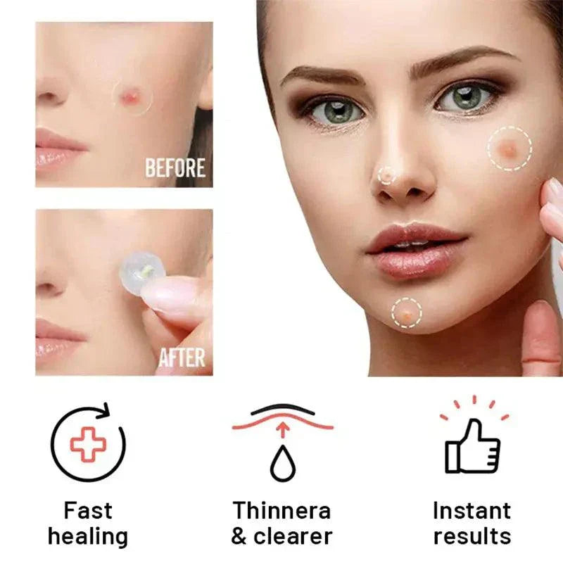 Acne Patch Duo day and night hydrocolloid blemish repair patches in packaging