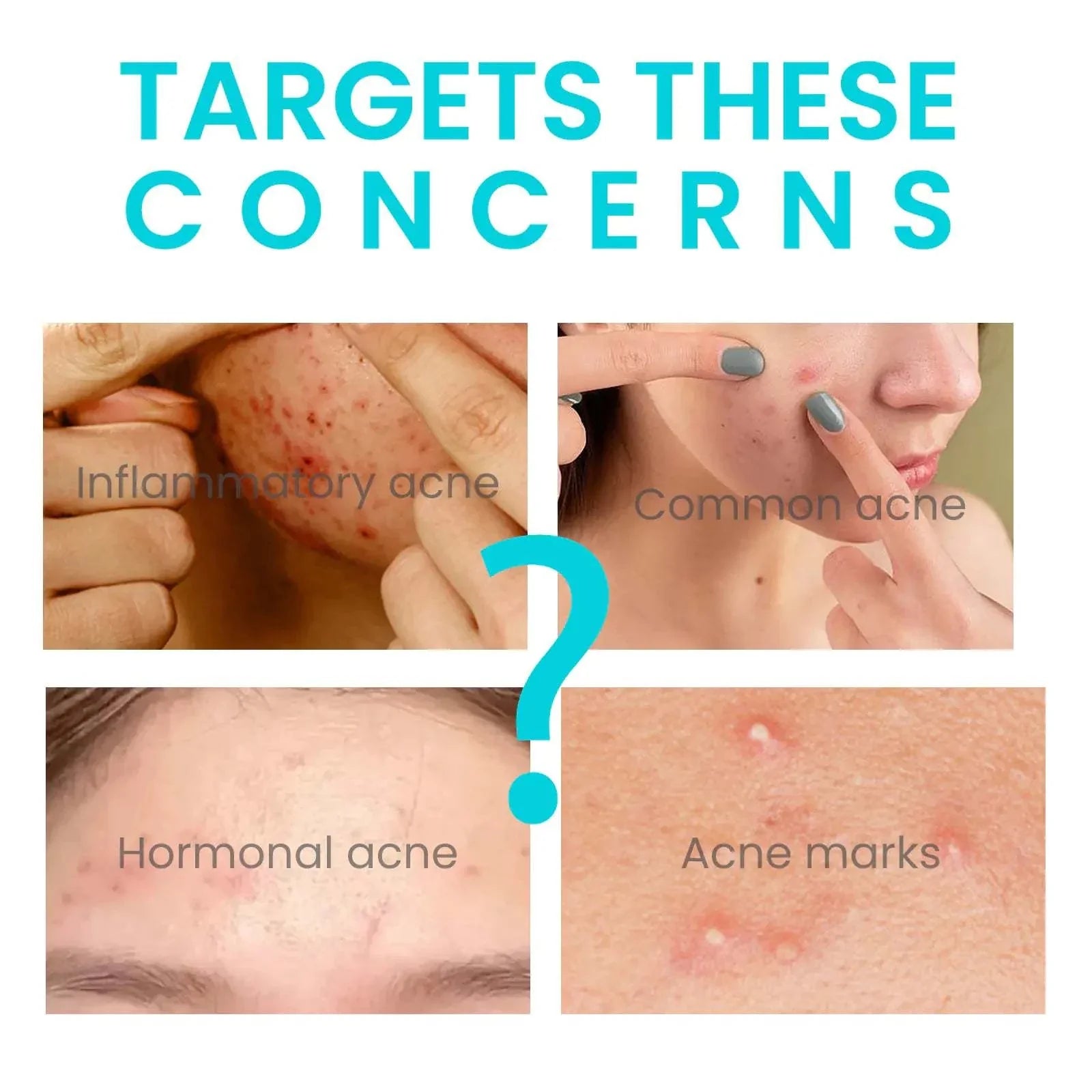 Jaysuing Whitening Anti-Acne Cream for inflammatory and hormonal acne