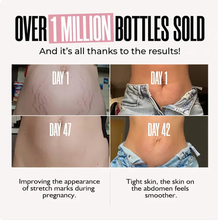 Before and after results of a product on stretch marks with text about sales and benefits.
