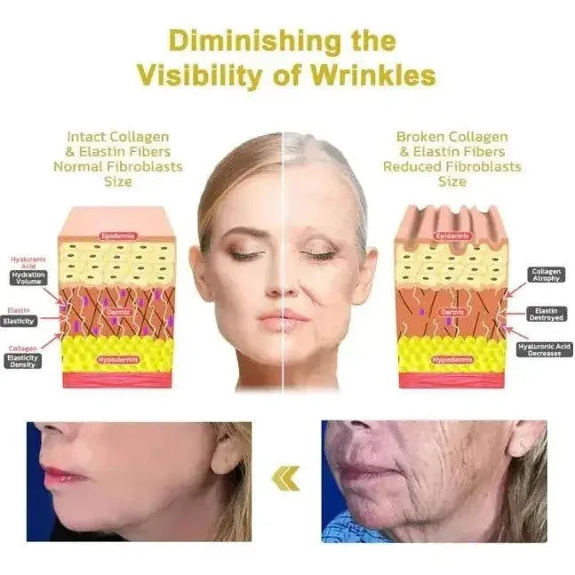 Diminishing the visibility of wrinkles with intact collagen and elastin fibers, showcasing bee venom anti-aging cream effects.